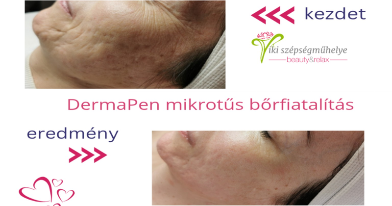 DermaPen mikrotűs bőrfiatalítás előtte és utána – bőrmegújítás